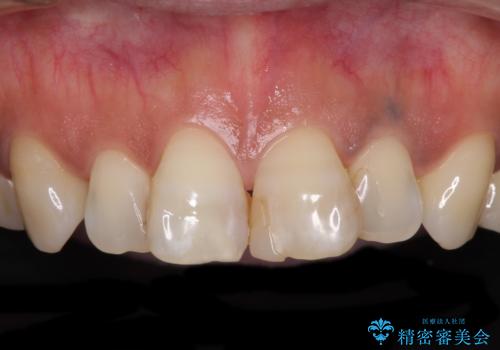 度重なる治療で前歯がしみる　オールセラミッククラウンによる補綴治療の症例 治療前