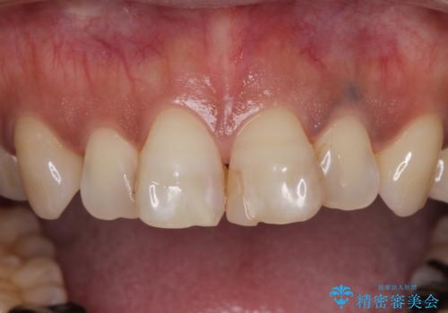 度重なる治療で前歯がしみる オールセラミッククラウンによる補綴治療の治療前