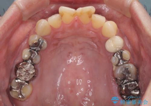 度重なる治療で前歯がしみる オールセラミッククラウンによる補綴治療の治療前