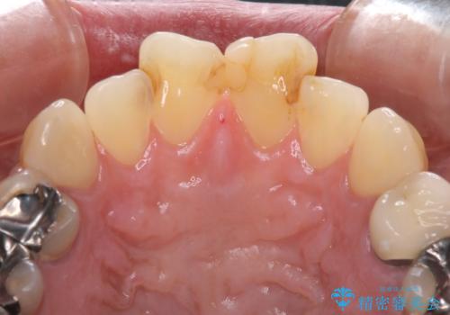 度重なる治療で前歯がしみる　オールセラミッククラウンによる補綴治療の治療前
