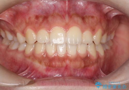 インビザライン　前歯のがたつきを目立たず矯正の症例 治療後