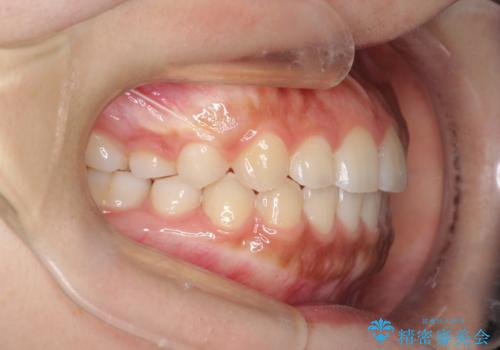 インビザライン 前歯のがたつきを目立たず矯正の治療後