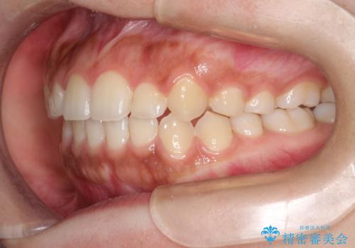 インビザライン 前歯のがたつきを目立たず矯正の治療後