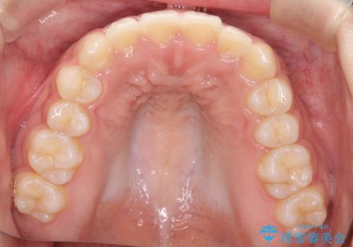 インビザライン　前歯のがたつきを目立たず矯正の治療後