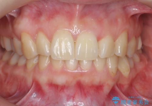 歯並びのがたつきを直したい ワイヤーは嫌 抜きたくないの治療後