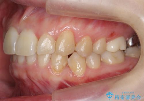歯並びのがたつきを直したい ワイヤーは嫌 抜きたくないの治療後