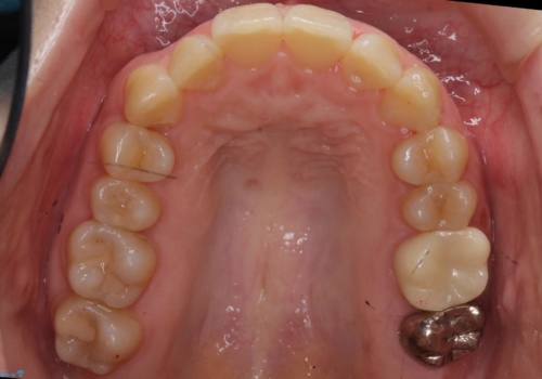 歯並びのがたつきを直したい ワイヤーは嫌 抜きたくないの治療後