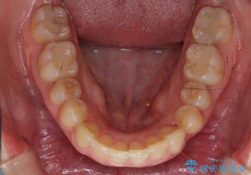 歯並びのがたつきを直したい ワイヤーは嫌 抜きたくないの治療後