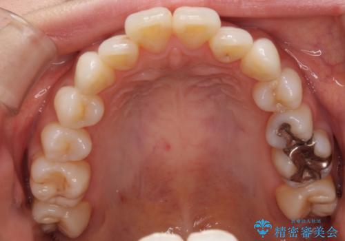 裏側のワイヤー矯正 抜歯して前歯をしっかり後ろに下げるの治療前