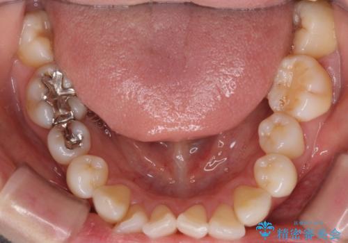 裏側のワイヤー矯正 抜歯して前歯をしっかり後ろに下げるの治療前