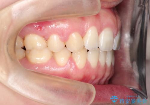 [口ゴボ] 口元が出ているのが気になる　ワイヤーによる抜歯矯正で口元をすっきりとの症例 治療後