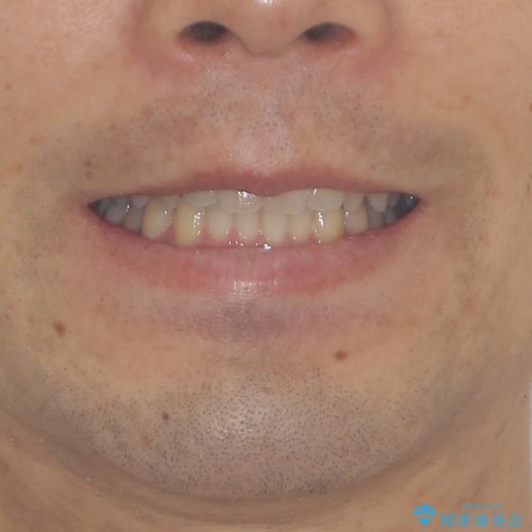 前歯の咬み合わせとデコボコを解消　インビザラインによる矯正治療の治療後（顔貌）