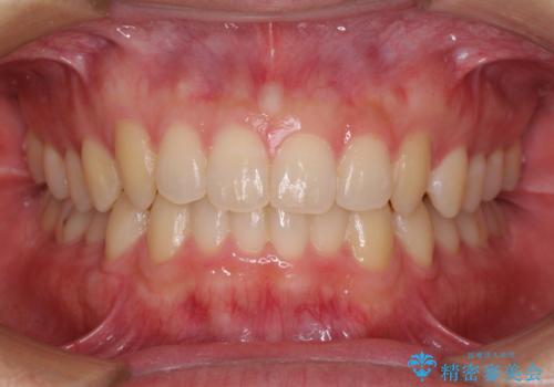 前歯の咬み合わせとデコボコを解消　インビザラインによる矯正治療