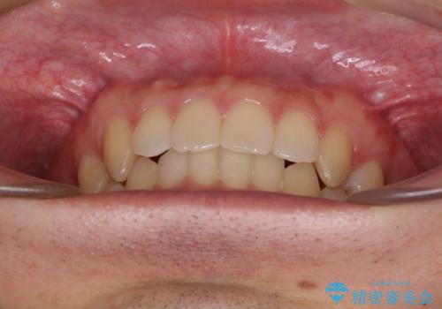 前歯の咬み合わせとデコボコを解消 インビザラインによる矯正治療の治療後