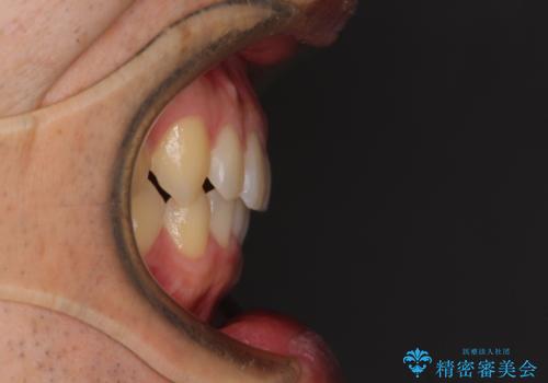 前歯の咬み合わせとデコボコを解消 インビザラインによる矯正治療の治療後