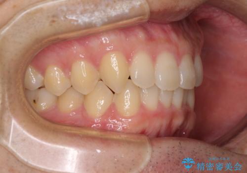 前歯の咬み合わせとデコボコを解消 インビザラインによる矯正治療の治療後