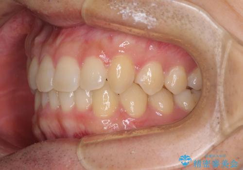 前歯の咬み合わせとデコボコを解消 インビザラインによる矯正治療の治療後