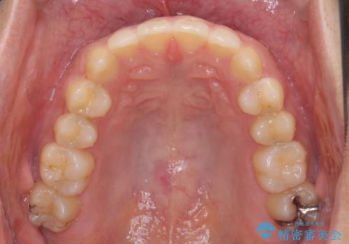 前歯の咬み合わせとデコボコを解消　インビザラインによる矯正治療の治療後