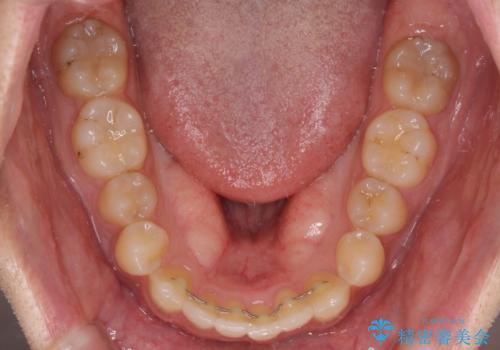 前歯の咬み合わせとデコボコを解消　インビザラインによる矯正治療の治療後