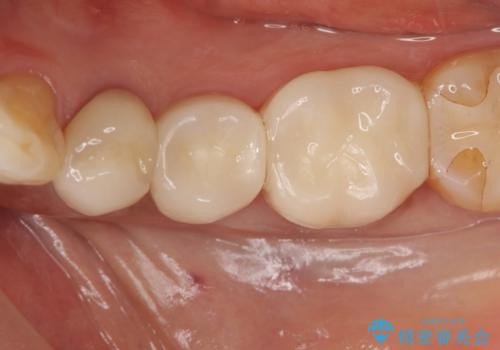 オールセラミッククラウン 奥歯の銀歯を白くの症例 治療後