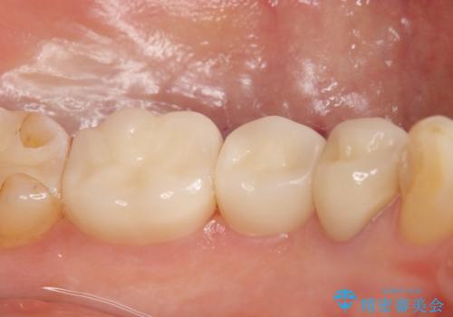 オールセラミッククラウン 奥歯の銀歯を白くの治療後