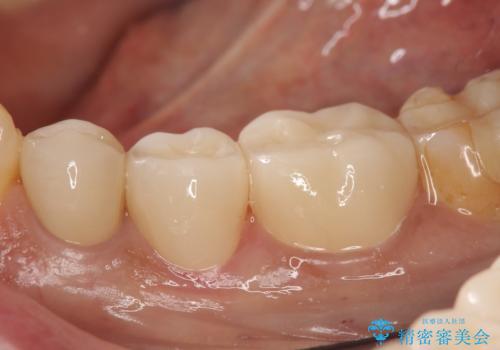 オールセラミッククラウン 奥歯の銀歯を白く