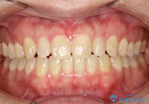 前歯の隙間　インビザラインにて整った歯並びへの治療後