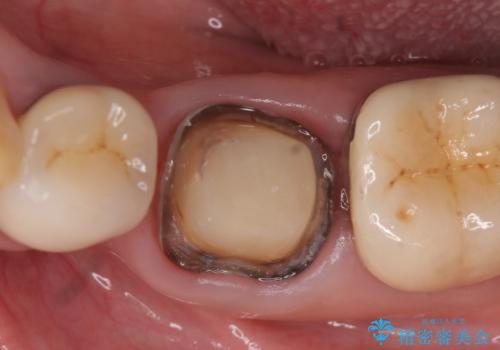 オールセラミッククラウン 痛くて咬めない奥歯の治療の治療中