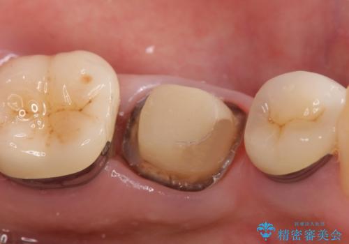 オールセラミッククラウン 痛くて咬めない奥歯の治療の治療中