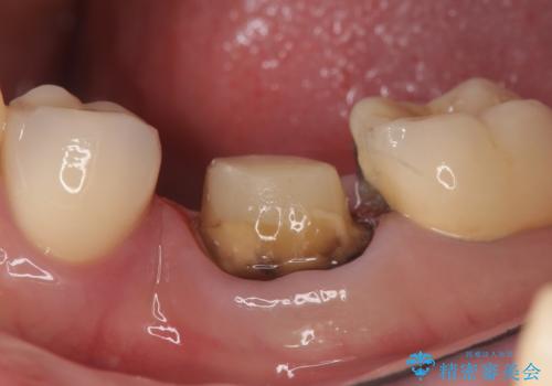 オールセラミッククラウン 痛くて咬めない奥歯の治療の治療中