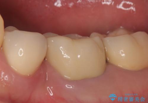 オールセラミッククラウン 痛くて咬めない奥歯の治療の症例 治療後