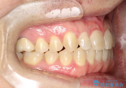前歯の隙間 インビザラインにて整った歯並びへの治療後