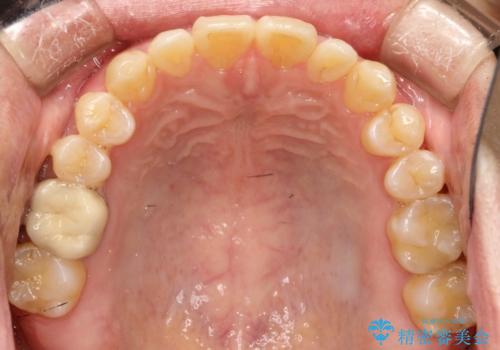 前歯の隙間 インビザラインにて整った歯並びへの治療後