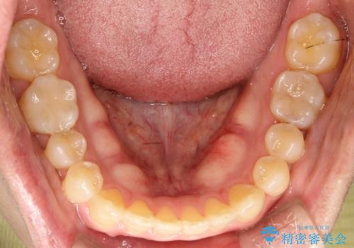 前歯の隙間 インビザラインにて整った歯並びへの治療後