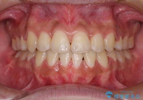 口元をスッキリと ワイヤーでの抜歯矯正