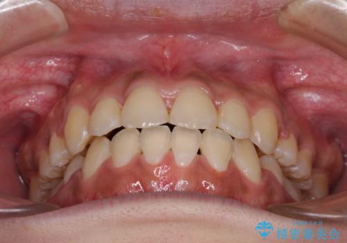 口元をスッキリと ワイヤーでの抜歯矯正の治療後