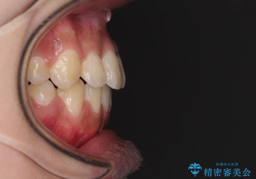 口元をスッキリと ワイヤーでの抜歯矯正の治療後