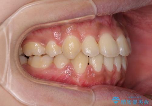 口元をスッキリと ワイヤーでの抜歯矯正の治療後