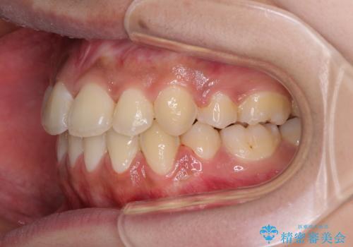 口元をスッキリと ワイヤーでの抜歯矯正の治療後