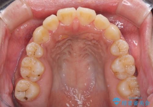 口元をスッキリと ワイヤーでの抜歯矯正の治療後