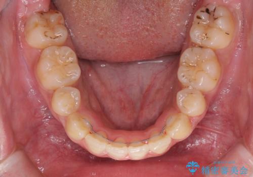 口元をスッキリと ワイヤーでの抜歯矯正の治療後