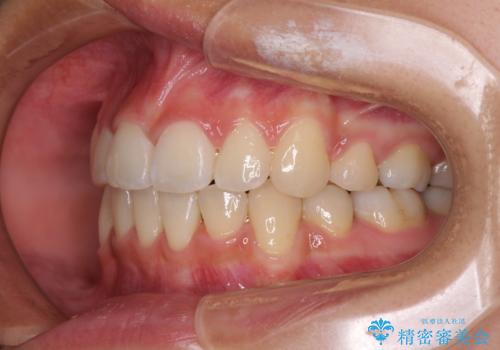 どんなに磨いても汚れが溜まる　抜歯矯正で清潔な口元にの治療後