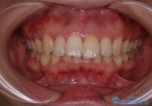 歯を白くしたい‐ウォーキングブリーチで内側から白くの治療中