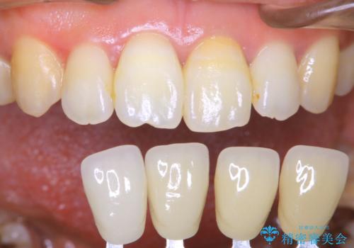歯を白くしたい‐ウォーキングブリーチで内側から白くの治療中