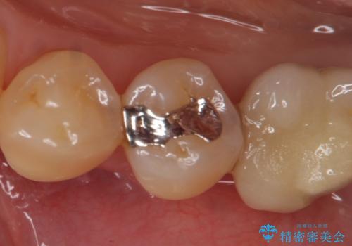 セラミックインレー 気になる銀歯を白くの症例 治療前