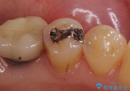 セラミックインレー 気になる銀歯を白くの治療前