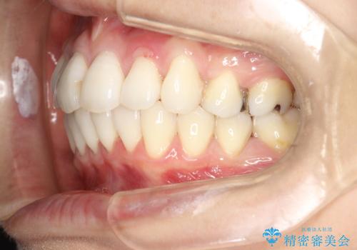 裏側のワイヤー矯正 抜歯して前歯をしっかり後ろに下げるの治療後