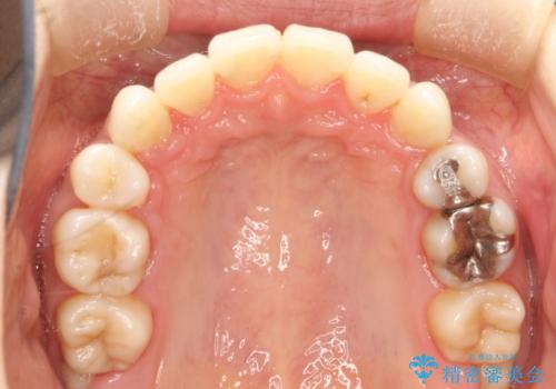 裏側のワイヤー矯正 抜歯して前歯をしっかり後ろに下げるの治療後