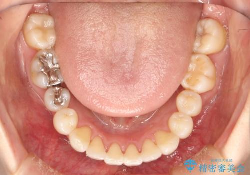 裏側のワイヤー矯正 抜歯して前歯をしっかり後ろに下げるの治療後