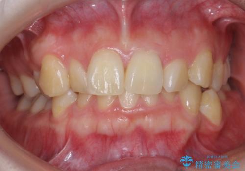 歯並びのがたつきを直したい ワイヤーは嫌 抜きたくないの治療前
